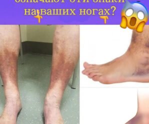 Плохая циркуляция: признаки, причины и лечение